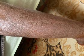 dry skin Large