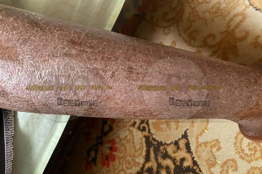 dry skin Large